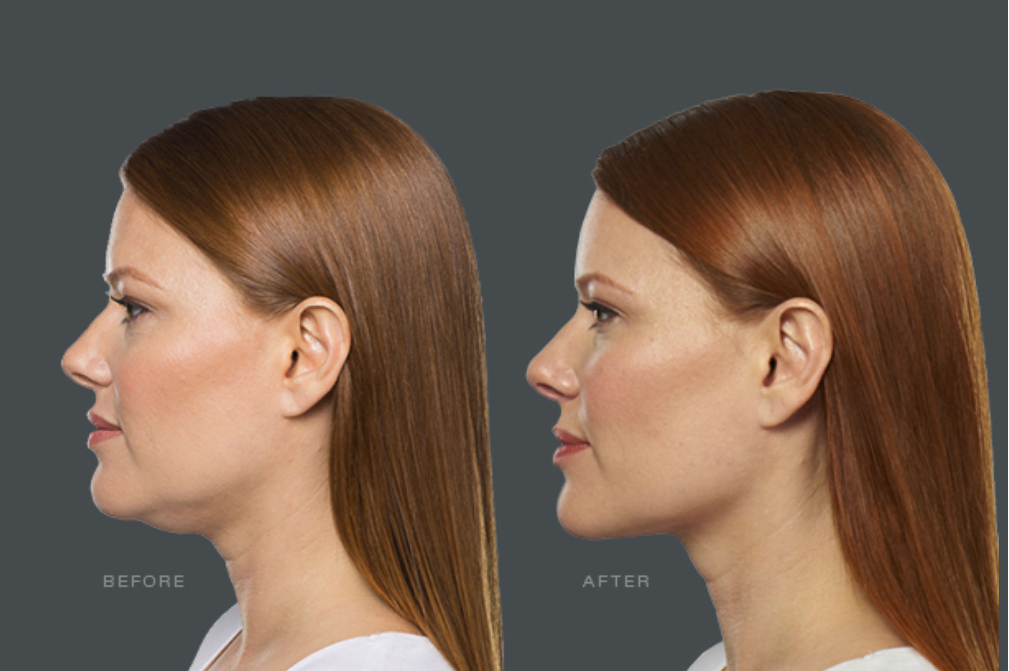 Kybella