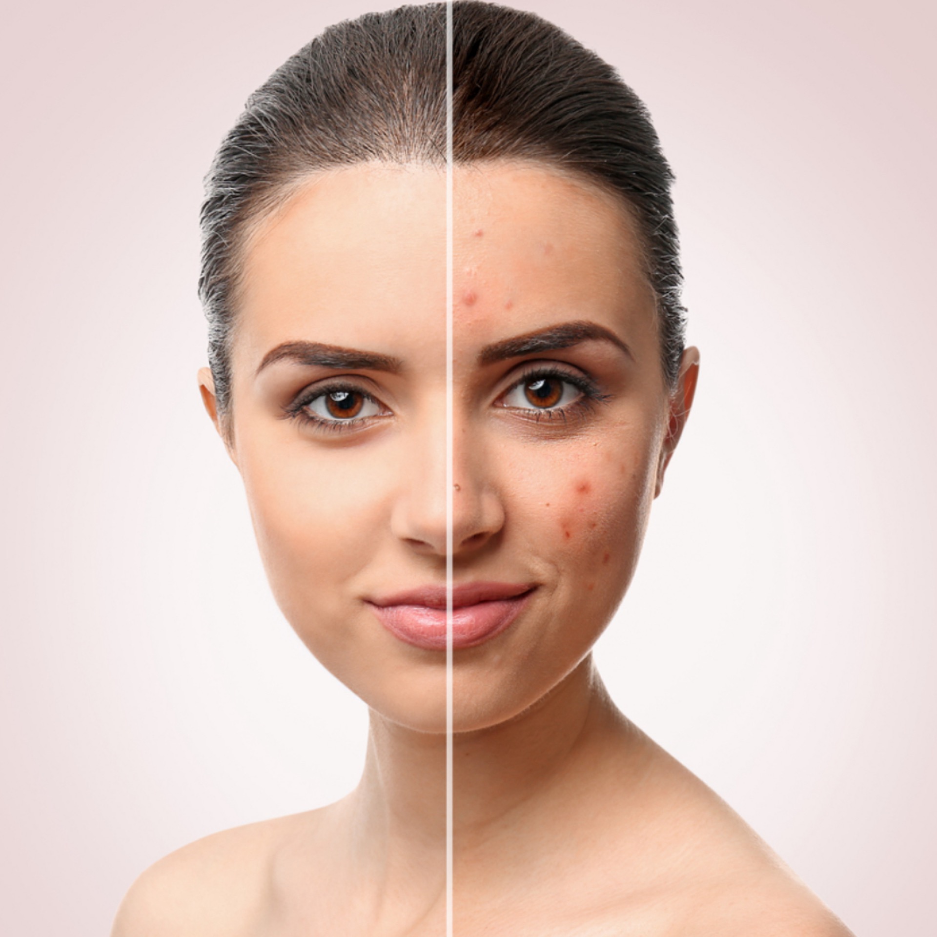Facial de acne en Gold Studio, Allentown, PA