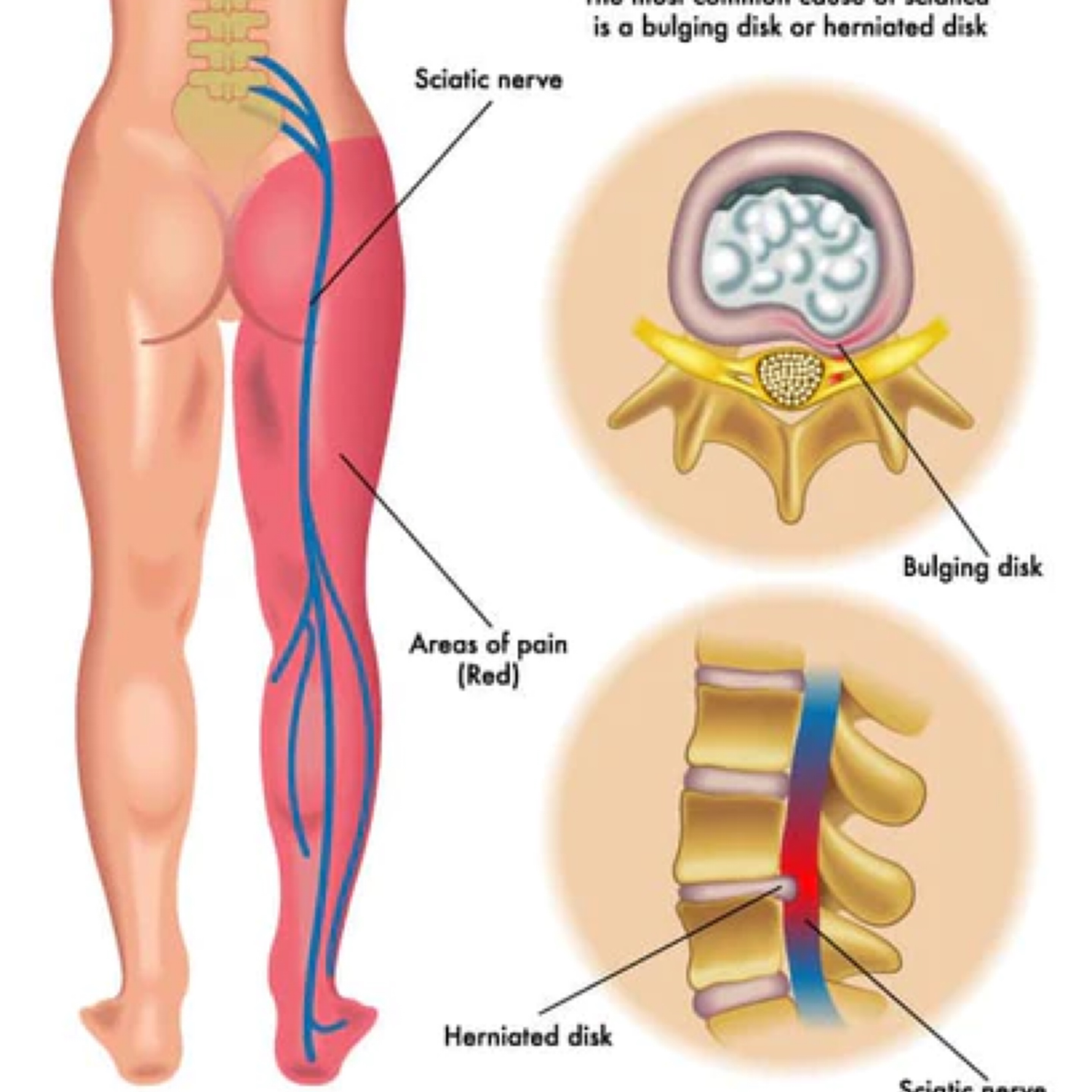 Sciatic Nerve
