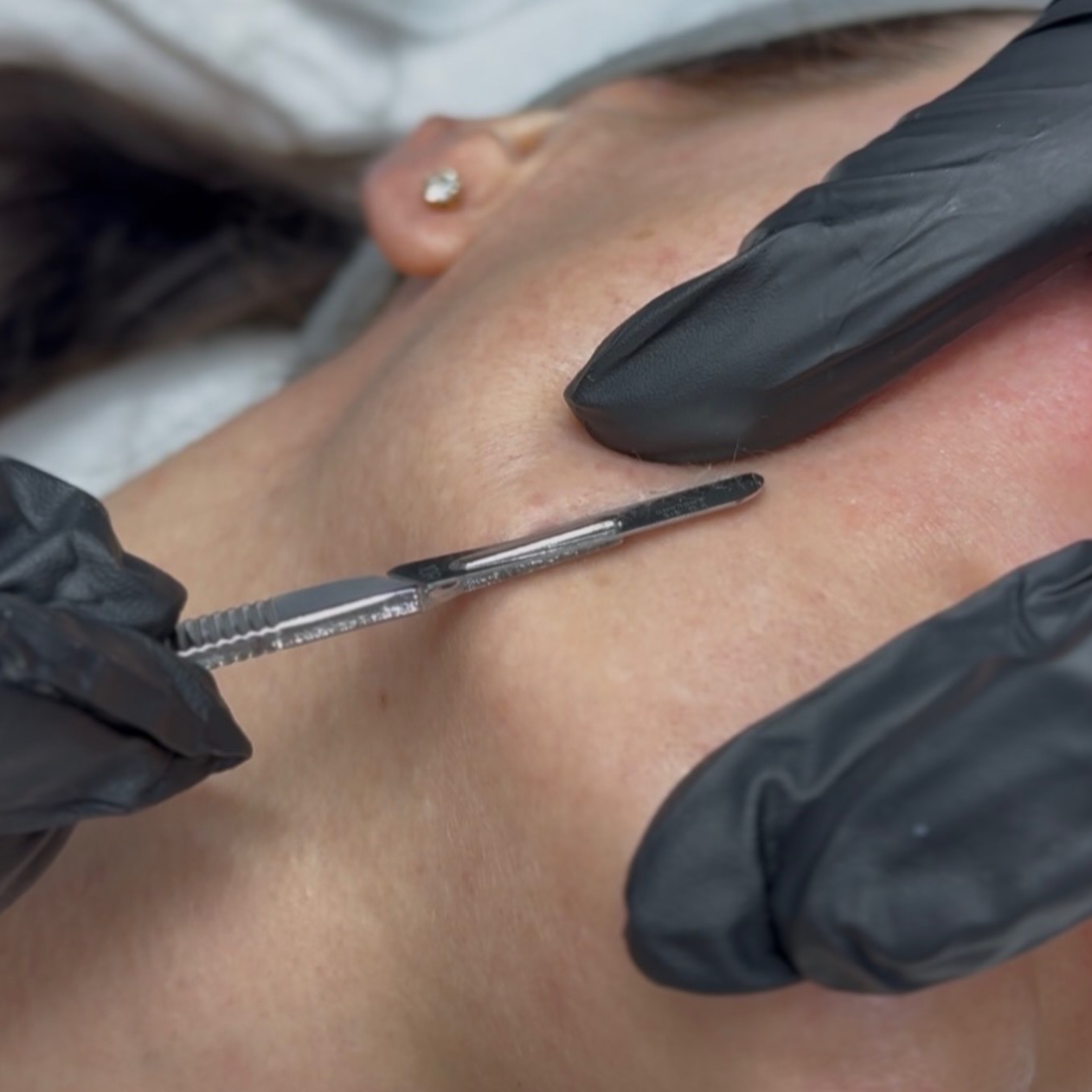 PRO Dermaplaning + Peptide Mask (PROMOTION) treatment in Calgary at MAesthetics Skin Atelier