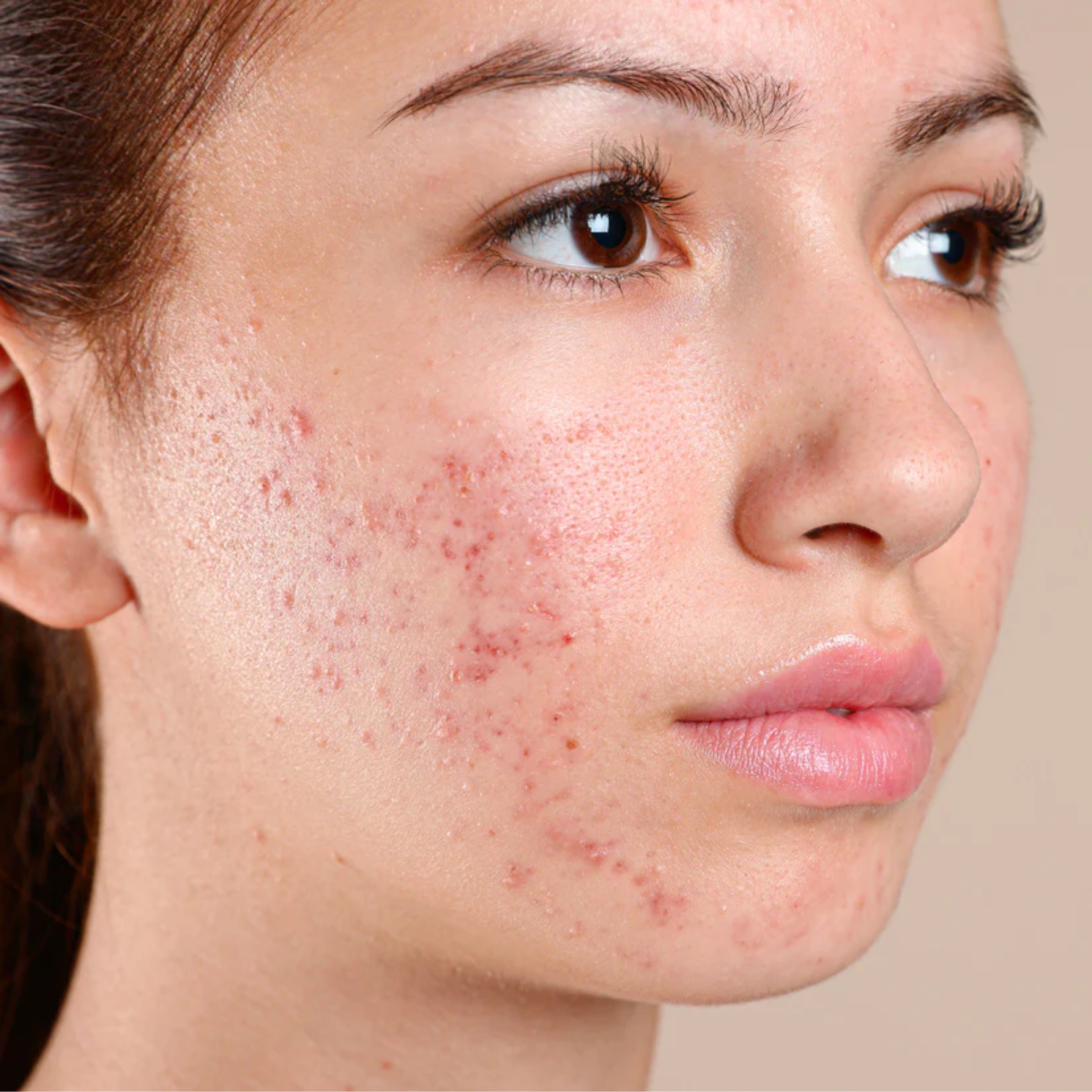 Clear Complexion