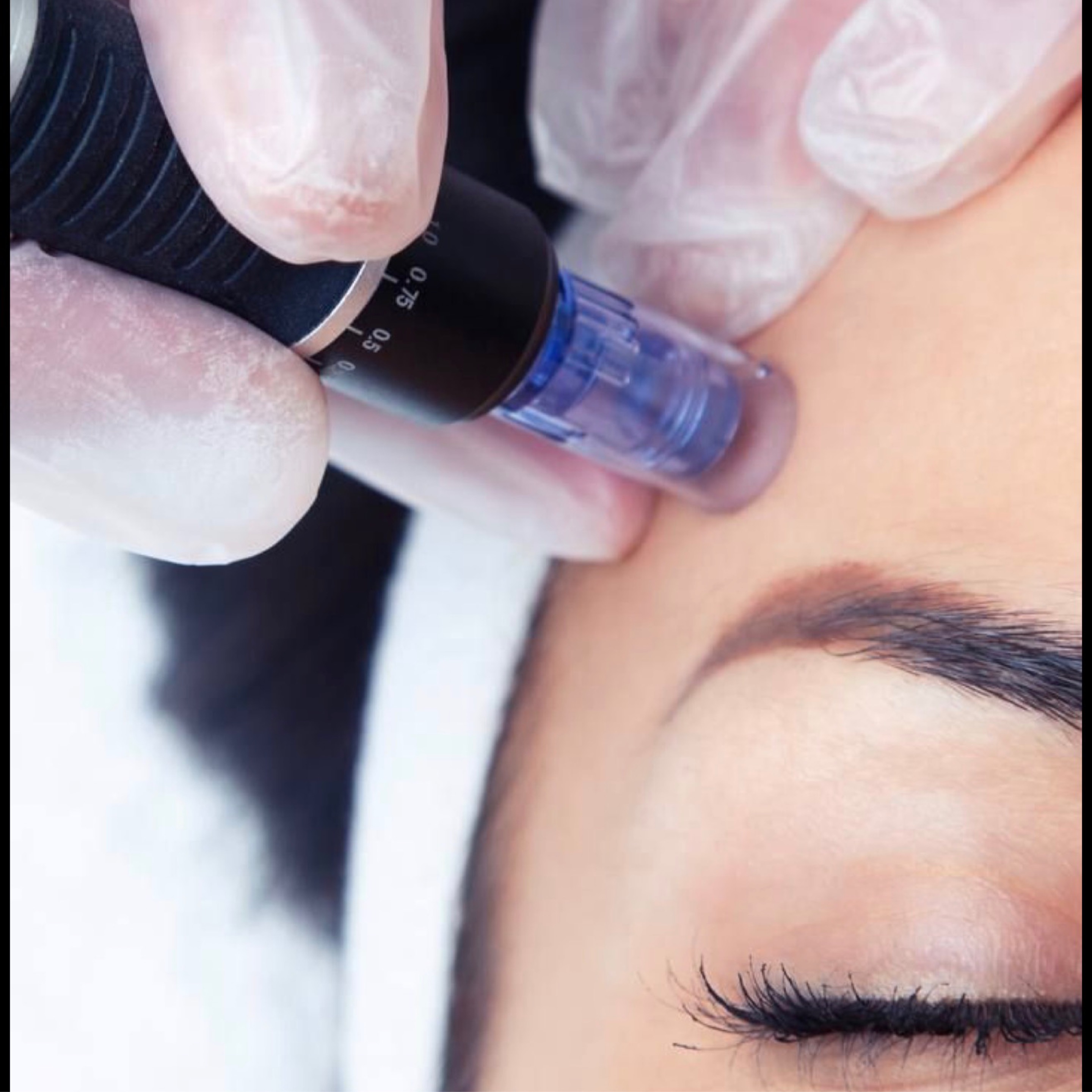 Microneedling collagen busting treatment in Calgary at MAesthetics Skin Atelier