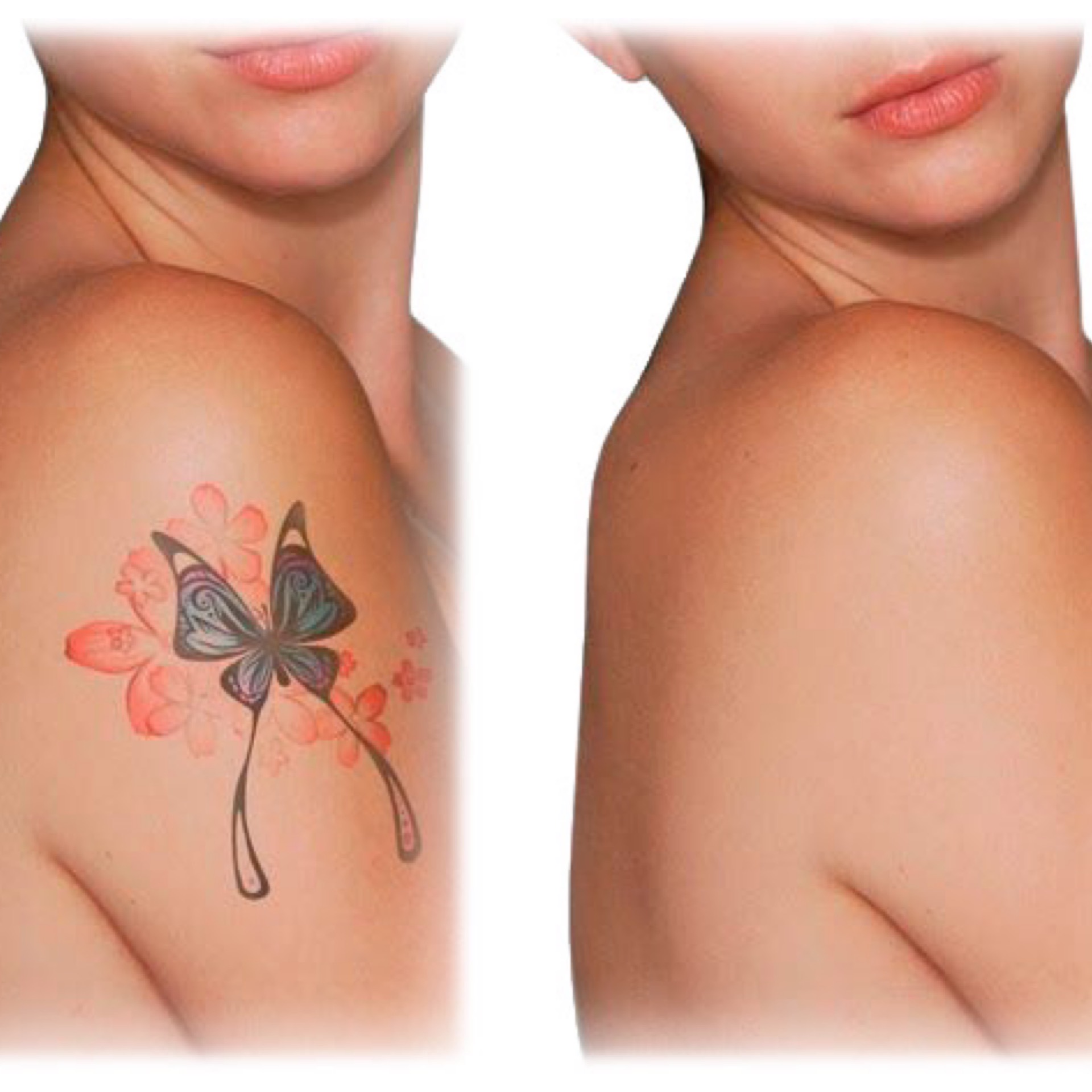 Remocion de tatuaje en Gold Studio, Allentown, PA