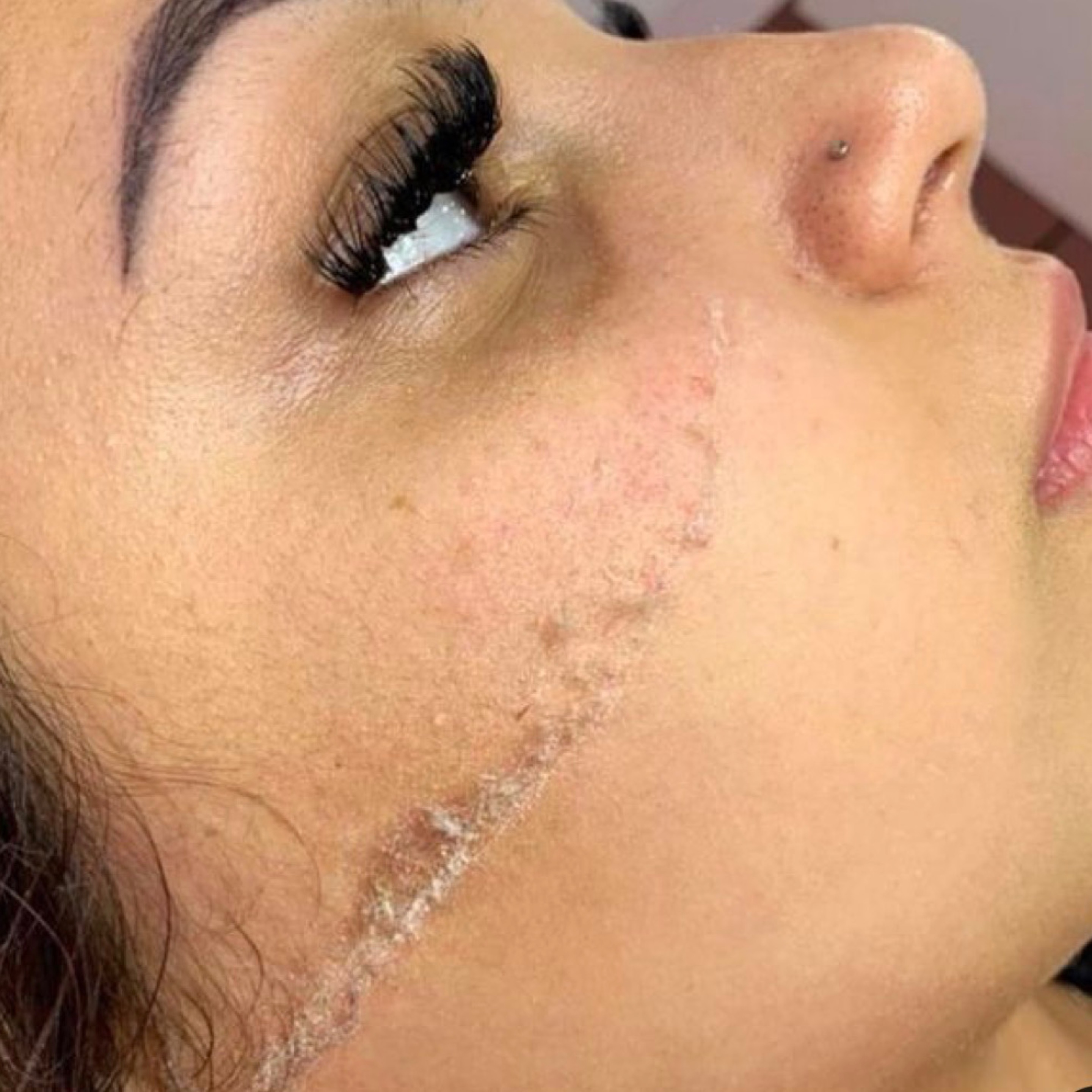 Dermaplaning skin renewals treatment in Calgary at MAesthetics Skin Atelier