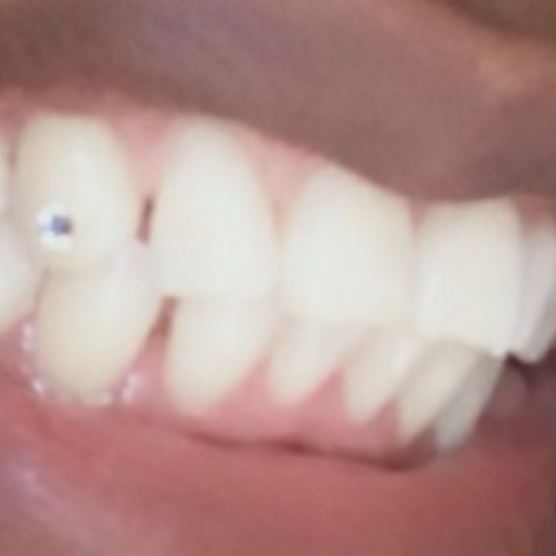 Teeth Whitening/Gem Combo- 60min & 1 Gem